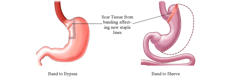 Conversion to gastric band