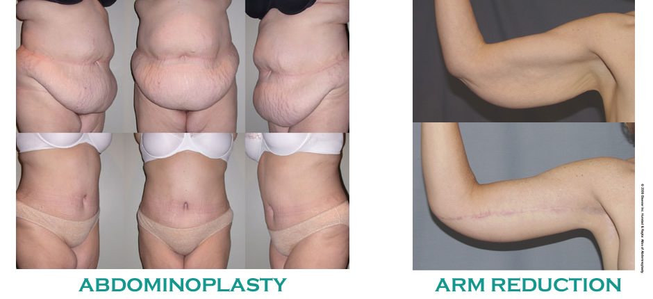 Body Contouring  Weight Loss Surgery