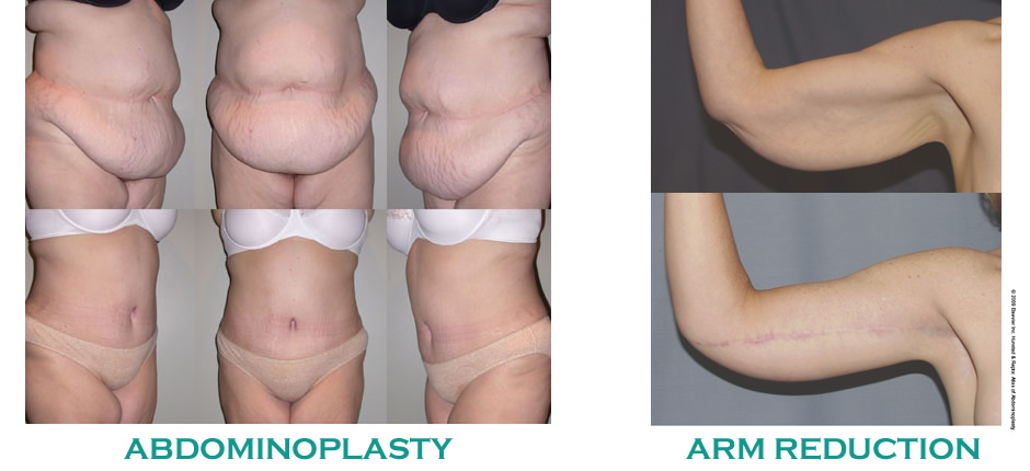 Panniculectomy Surgery  Post-Bariatric Body Contouring