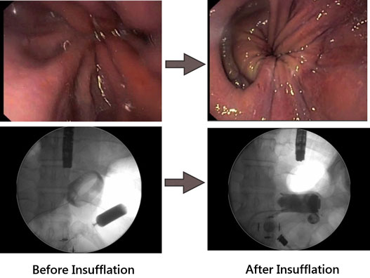 Complications after Weight Loss Surgery