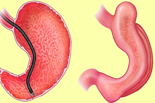 Endoscopic Sleeve Gastroplasty